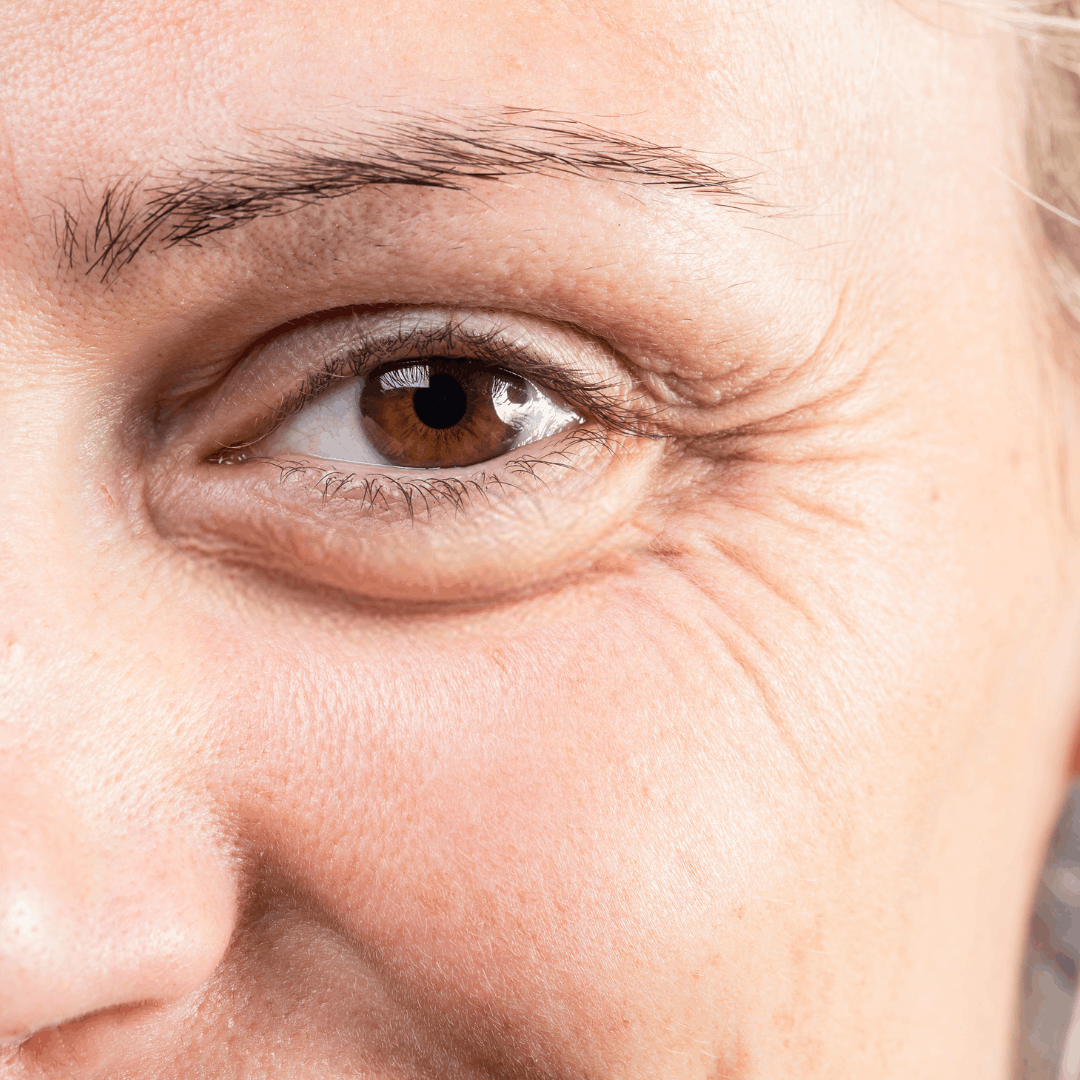 Botulinumtoxin – Injektionen REVÙ CLINIC